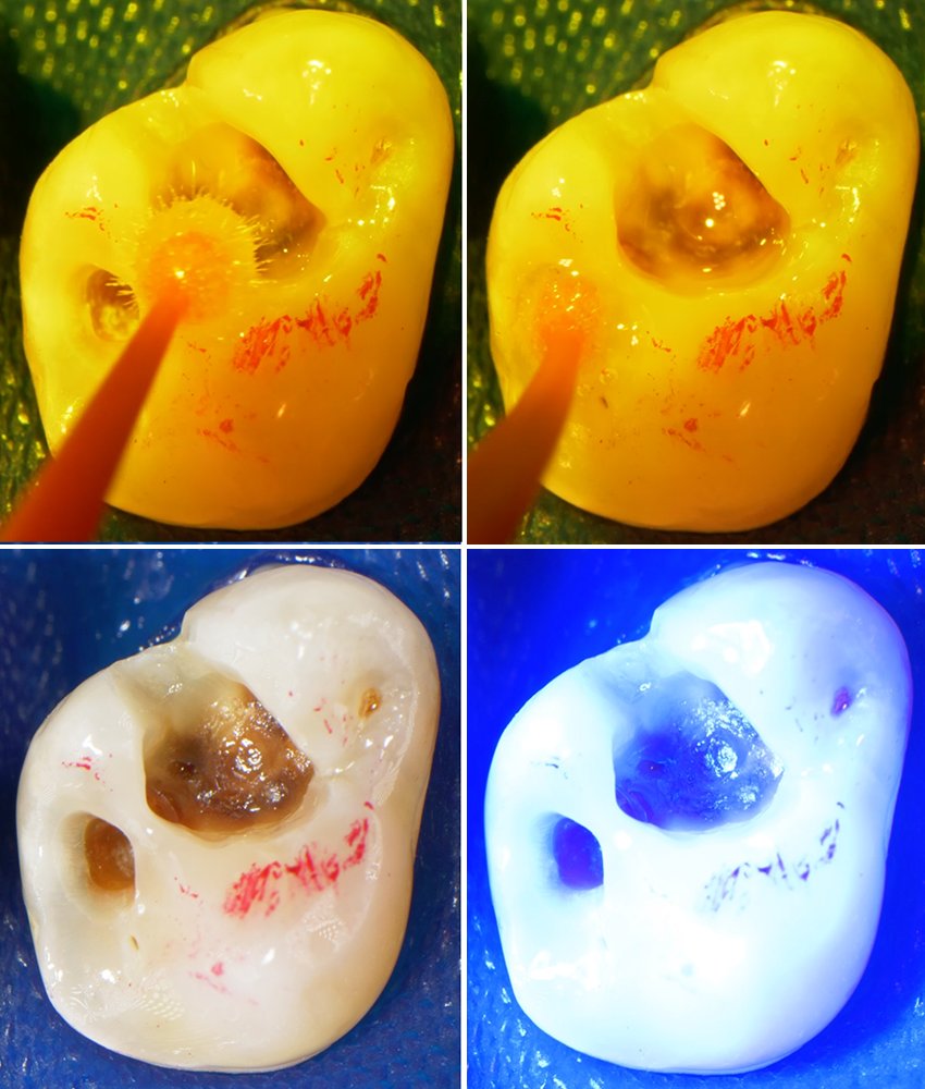 Informative oral care related imagery with a file name of final-zirconia-restorations.jpg shown on Solventum's "Brain Floss" blog