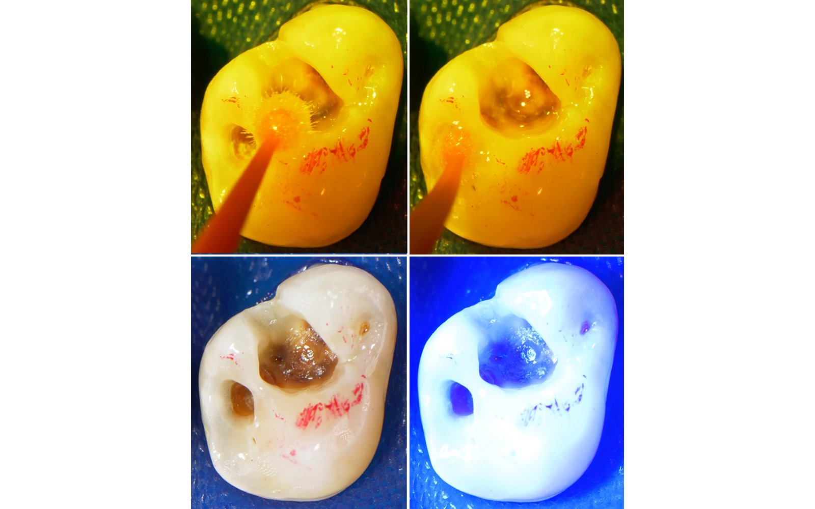 Informative oral care related imagery with a file name of final-zirconia-restorations.jpg shown on Solventum's "Brain Floss" blog