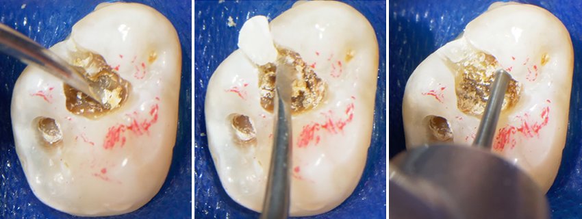 Informative oral care related imagery with a file name of polished_restoration_10.jpg shown on Solventum's "Brain Floss" blog