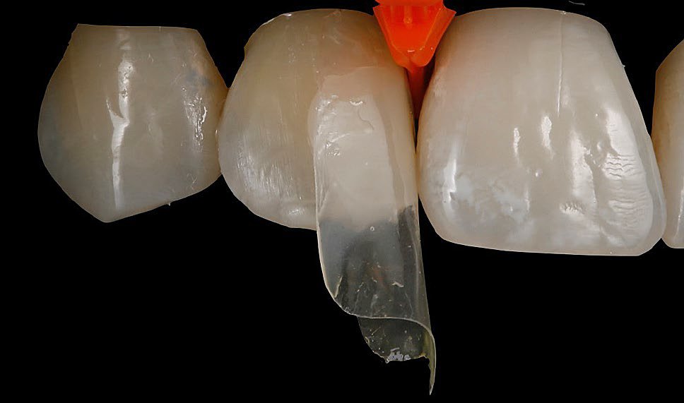 Warmed 3M™ Filtek™ Universal Restorative shade B2 was injected into the flowable causing hydrolysis to push the flowable out of matrix
