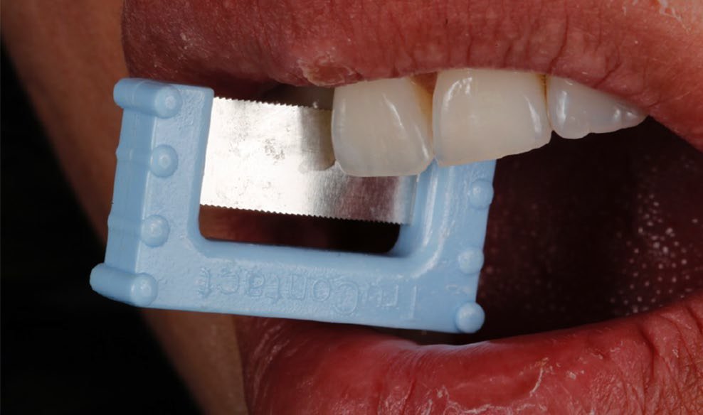 clear the contact of tartar buildup