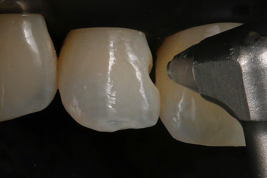 Teeth cleaning using Bioclear Blaster