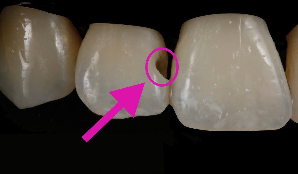 The finished, cleaned prep showed the radius bevel leading out to an infinity margin