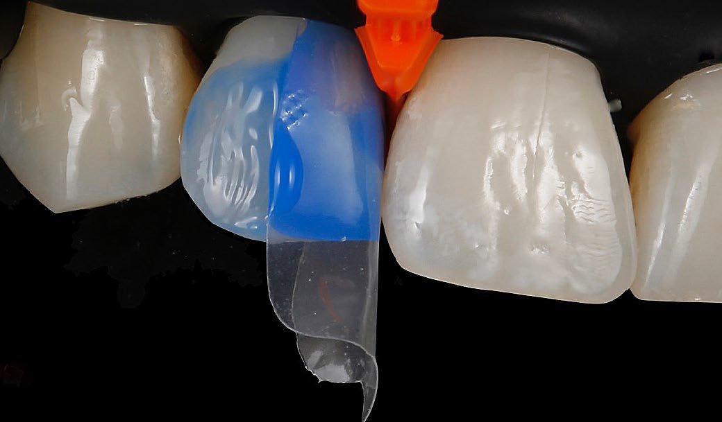 Total-etch technique (3M™ Scotchbond™ Universal Etchant) was used for the bonding procedure