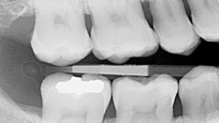 Bitewing radiograph of the initial situation