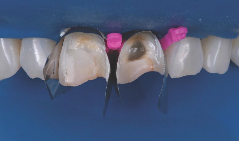 Teeth with two anterior mactrics