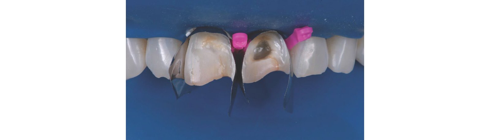 Teeth with two anterior mactrics