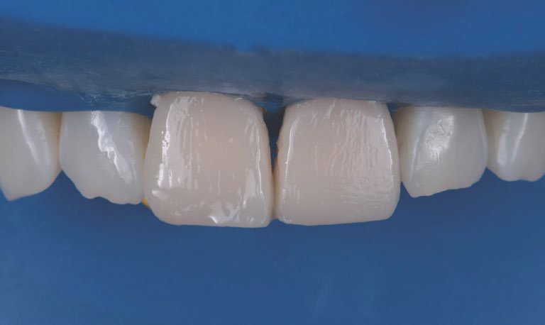 Appearance of the teeth after the first application of 3M™ Filtek™ Universal Restorative