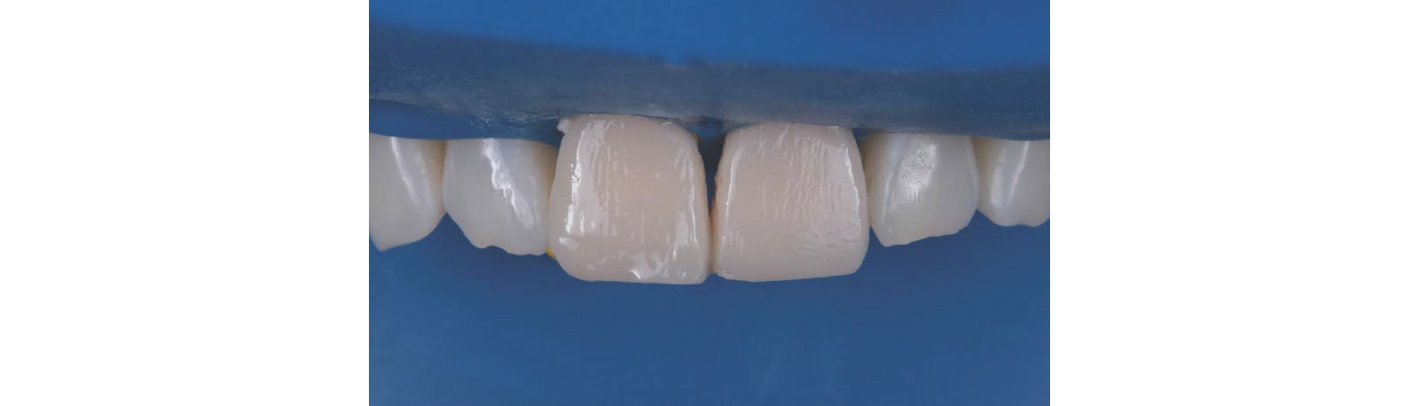 Appearance of the teeth after the first application of 3M™ Filtek™ Universal Restorative