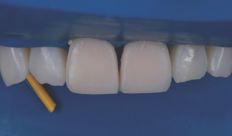 Restorations after polishing using the 3M™ Sof-Lex™ Diamond Polishing System.