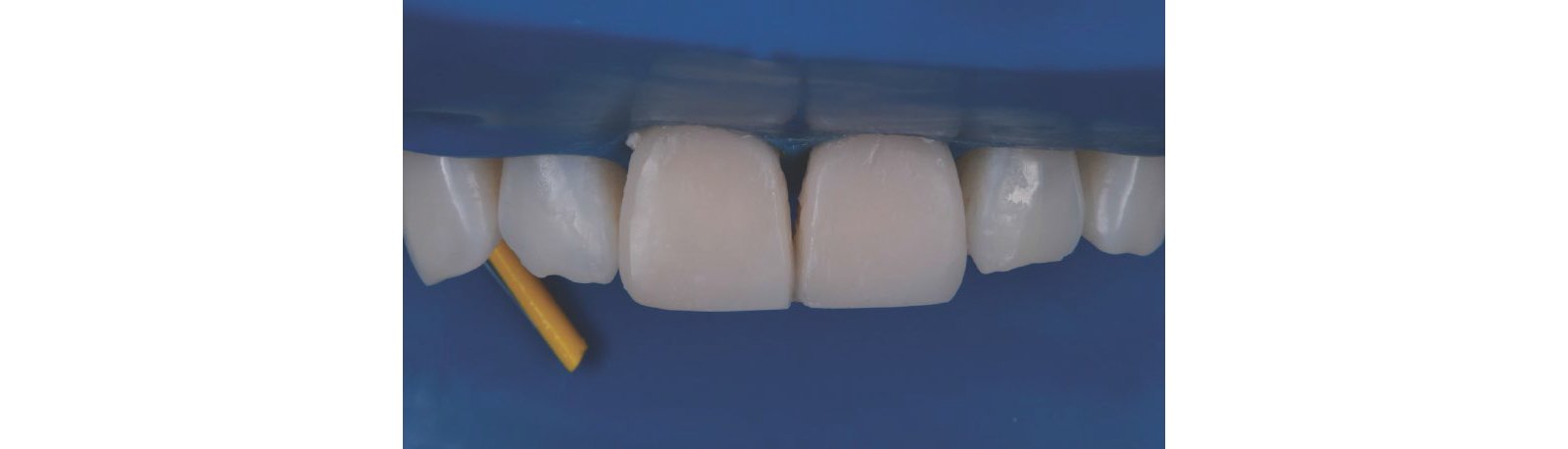 Restorations after polishing using the 3M™ Sof-Lex™ Diamond Polishing System.