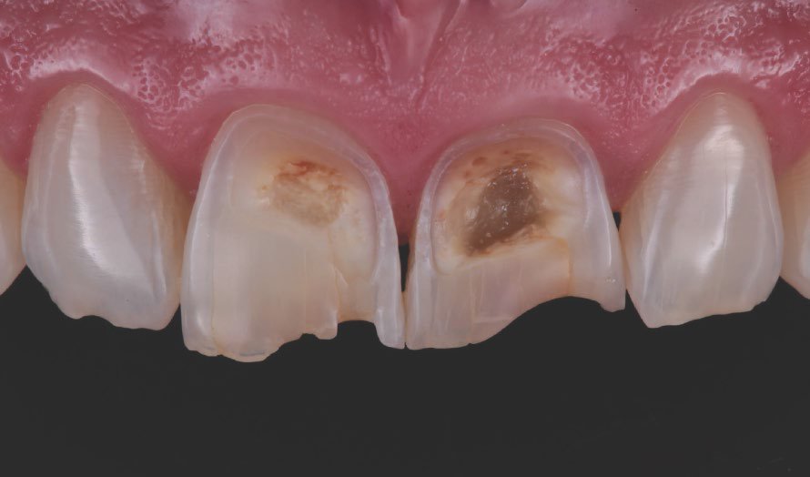 Detailed view of the maxillary incisors