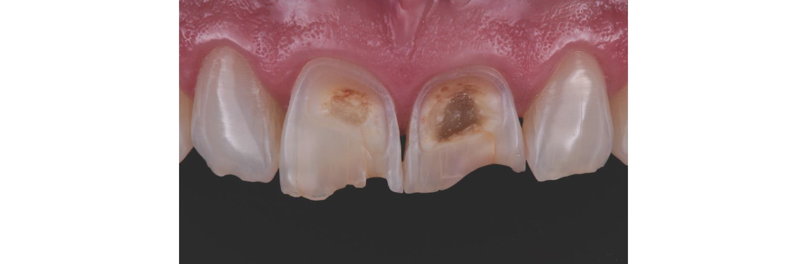 Detailed view of the maxillary incisors
