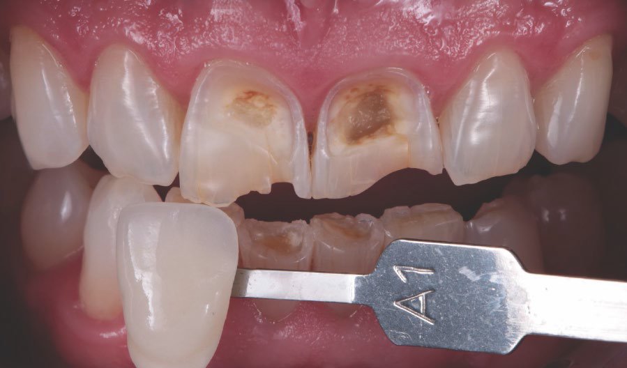 Tooth shade was determined with the aid of the VITA classical A1-D4® shade guide