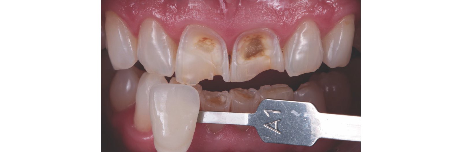 Tooth shade was determined with the aid of the VITA classical A1-D4® shade guide