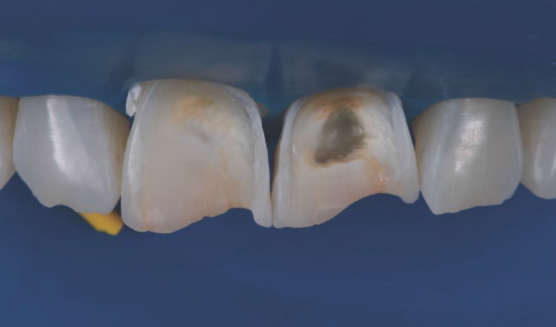 The preparation procedure resulted in a round form and a micro-retentive surface structure