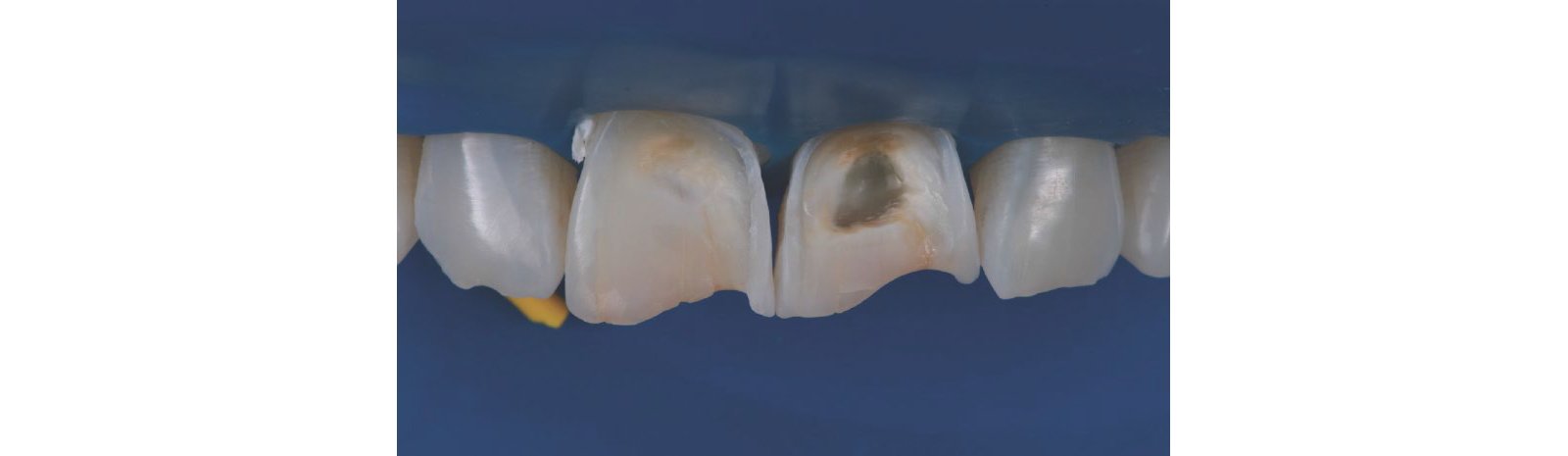 The preparation procedure resulted in a round form and a micro-retentive surface structure
