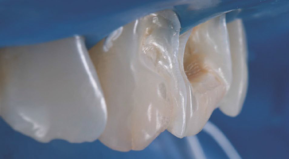 Lateral view of the prepared teeth.