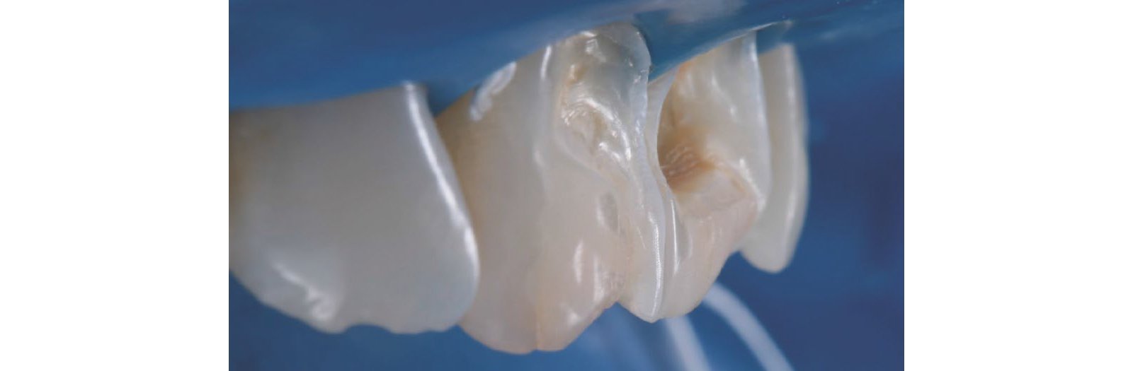 Lateral view of the prepared teeth.