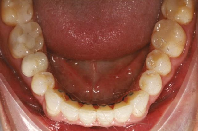 Post-treatment occlusal after lingual fixed retainer reapplied