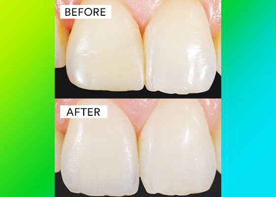 close up before and after of tooth