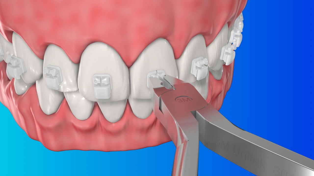 3M™ Clarity™ Ultra Self-Ligating Brackets | Solventum 3M™ Clarity™ Ultra Self-Ligating Brackets | Solventum