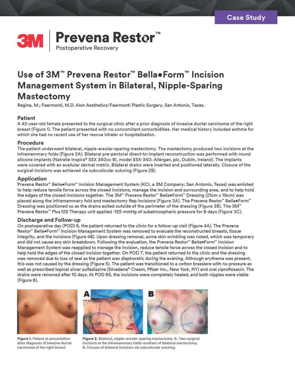 Prevena Restor BellaForm incision management system for mastectomy case study cover preview