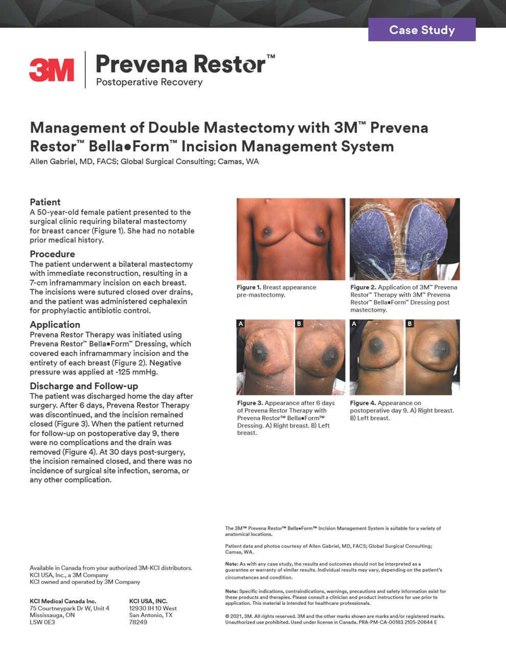 Prevena Restor BellaForm incision management system for double mastectomy case study cover preview