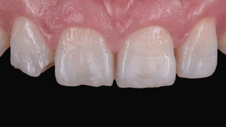 Affected maxillary teeth