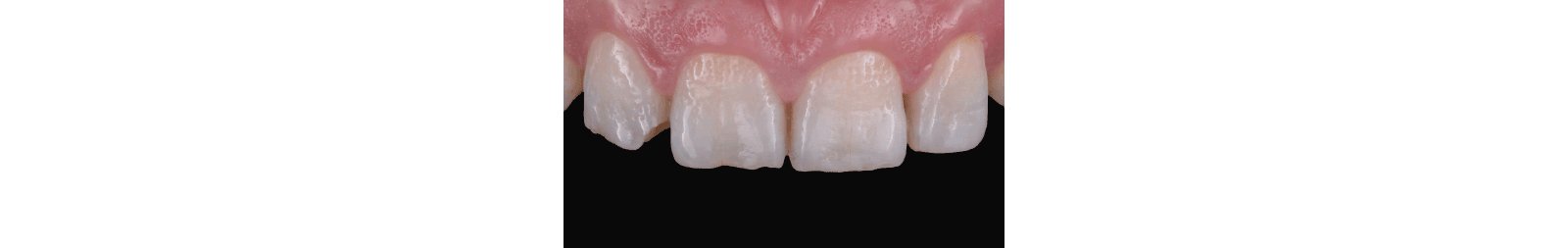 Affected maxillary teeth