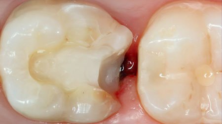 Gingival tissue