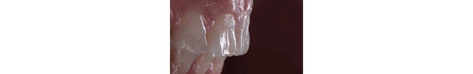 Surface irregularities