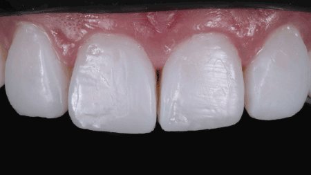 Appearance of teeth after application