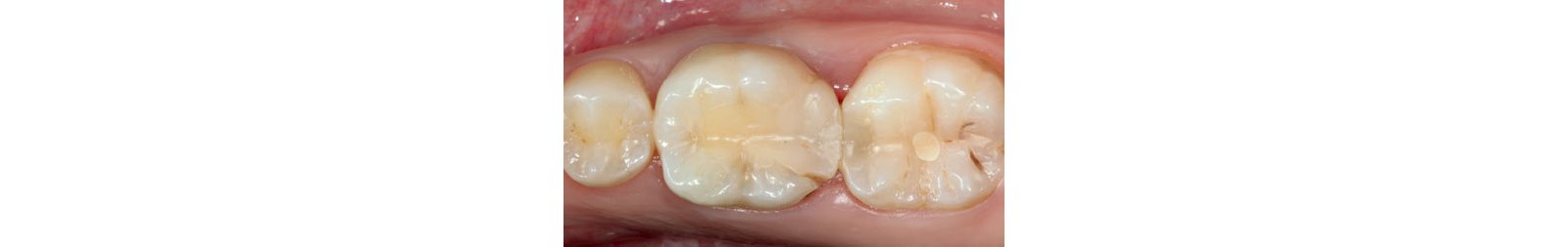 Lower molar