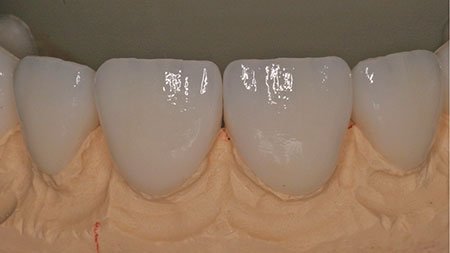 Lab created final restorations