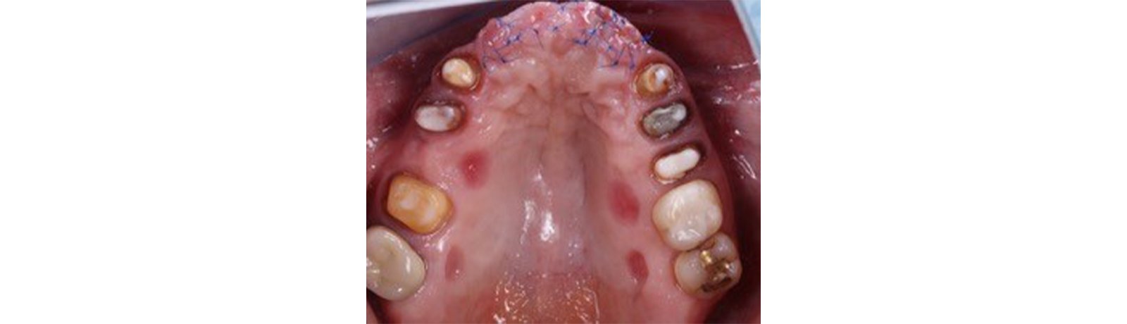 Informative oral care related imagery with a file name of FUR_CC_Direct_Anterior_Solution_Manauta_5.jpg shown on Solventum's "Brain Floss" blog