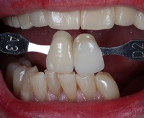 Informative oral care related imagery with a file name of Provisionals_Fig.-11.jpg shown on Solventum's "Brain Floss" blog