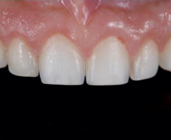 3M™ Ketac™ Universal Aplicap™ Glass Ionomer Restorative