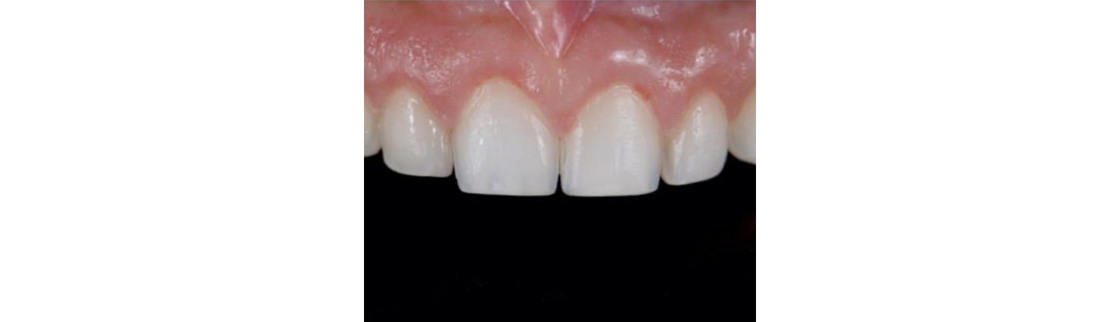 3M™ Ketac™ Universal Aplicap™ Glass Ionomer Restorative
