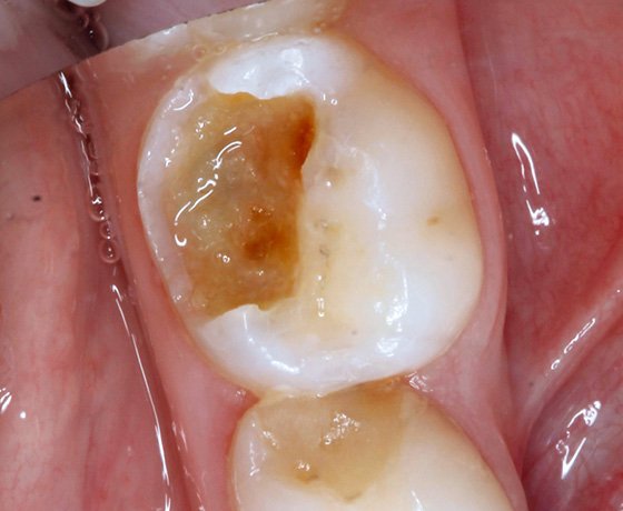 Occlusal view