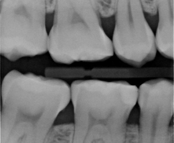 bite-wing radiograph