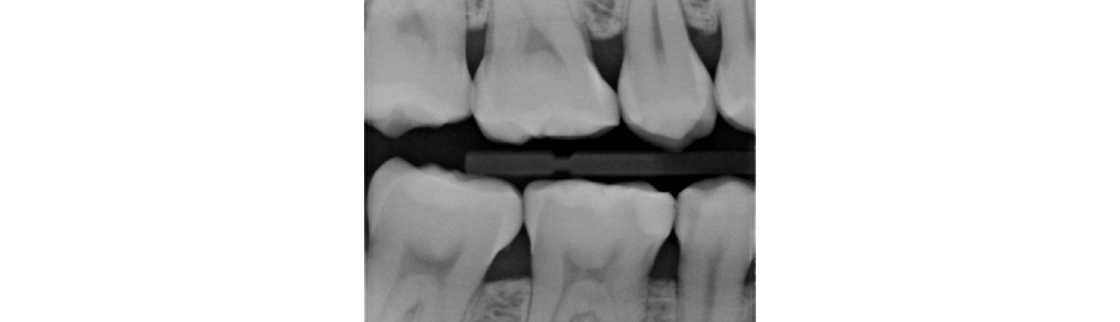 bite-wing radiograph