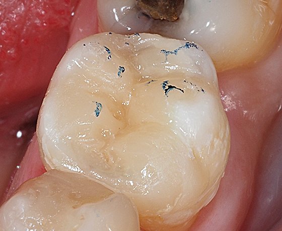 Occlusal contacts