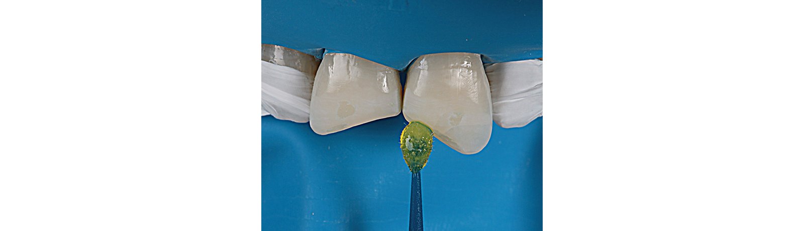 Selective enamel etch