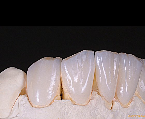 Feldspathic glass ceramic veneers 