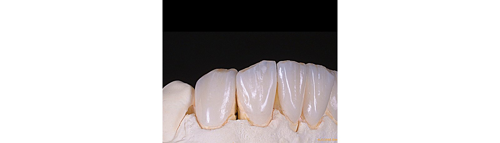 Feldspathic glass ceramic veneers 