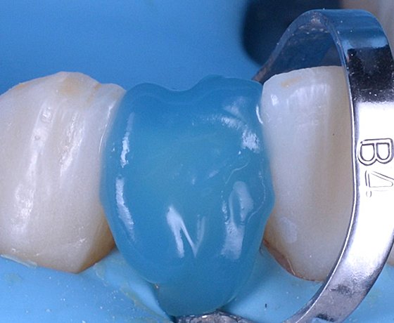 Close up of adhesive on tooth