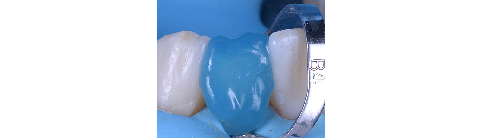 Close up of adhesive on tooth
