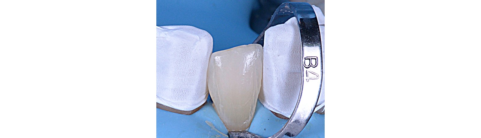 Close up of tooth prepped for veneer application