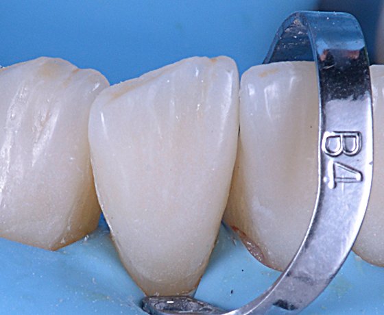 Close up of veneer